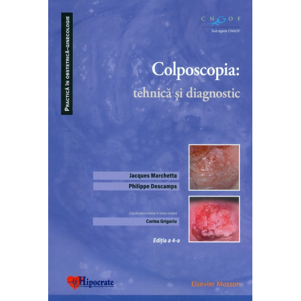 Colposcopia: tehnica si diagnostic