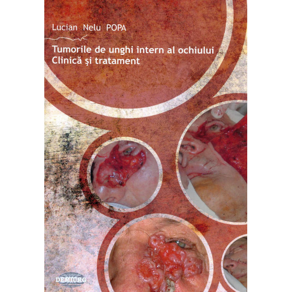 Tumorile de unghi intern al ochiului. Clinica si tratament